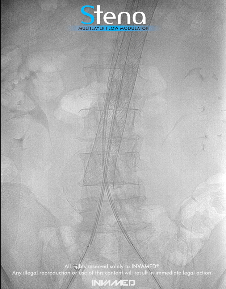 Aortenaneurysmen: Erkundung des Stena Multilayer Flow Modulators