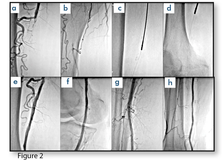 Temren Atherectomy System-5