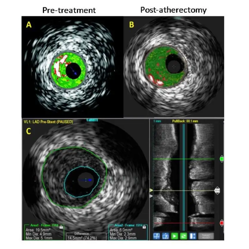 Temren Atherectomy System-6